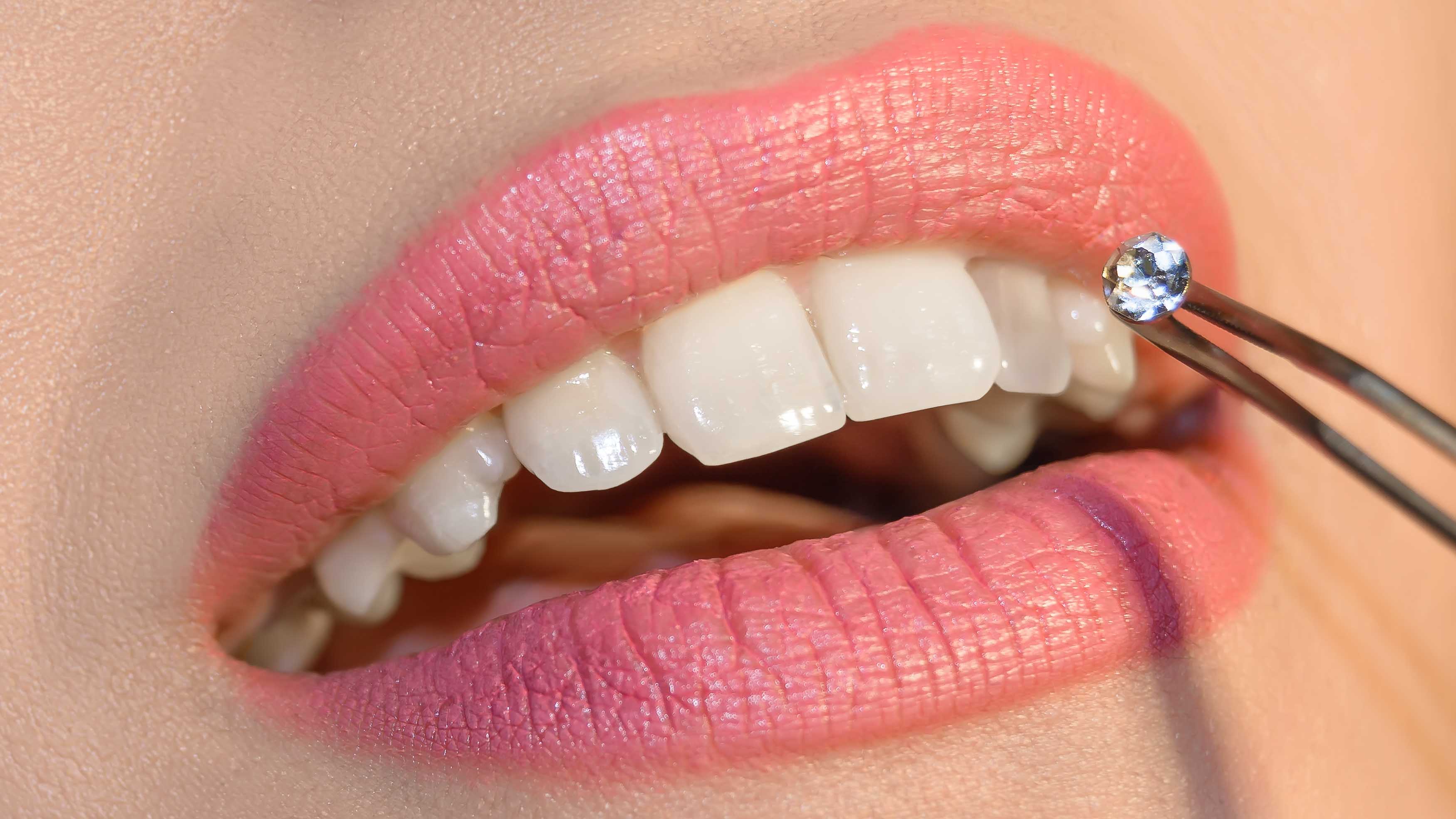 Diamant-Steinchen auf dem Zahn: ein Trend kehrt zurück